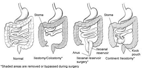 What is a diverting colostomy?